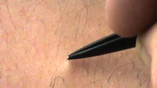 Juicy Ingrown Hair