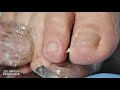 ep. 243 dig out ingrown toenail