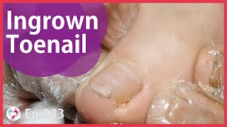 Ep. 243 - Dig Out Ingrown Toenail