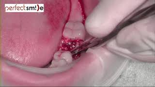 Immediate dental implant placement plus Osteobiol MP3 graft + CTG