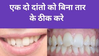 बिना तार बनवाए दातों को ठीक करें// Teeth correction without braces//बाहर निकाले दांतो का इलाज