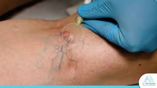 Sclerotherapy for Spider Veins | Dr. Ali Haydar | عمليّة حقن و تصليب الأوردة