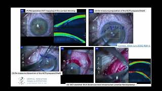 SILK GABISON Sclero-Corneal Intrastromal Lamellar Keratoplasty