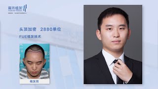 頭頂加密植髮效果怎麼樣？最好的植髮是哪家！Yonghe hair transplant