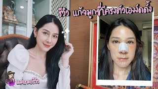 รีวิว แก้จมูก ซี่โครงตัวเองงัดดั้ง ไร้ซิลิโคน กับหมอ? ทำที่? ราคาหลักแสน