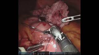 DMH Robotic Retrocolic Retrogastric Roux-en-Y Gastric Bypass