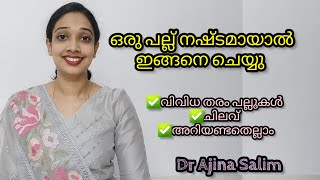 പല്ല് നഷ്ടമായാൽ ചെയ്യണ്ടത് |Different teeth replacing methods |dental talk Malayalam Dr Ajina Salim