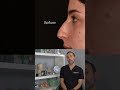 ultrasonic rhinoplasty explained by dr. kian