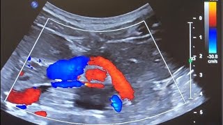 Brief Liver Doppler Example