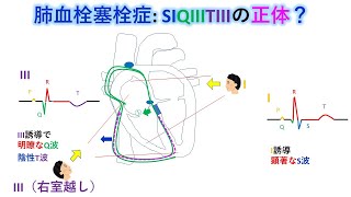 心電図：暗記からの卒業 109話 肺血栓塞栓症