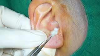 Epidermal Cyst on Ear Removal Surgey (HD) 귓볼 표피 낭종 귓볼 피지 낭종 귀 표피낭종 귀 피지낭종제거 수술 수원 광교 유디트 성형외과 닥터랜사부