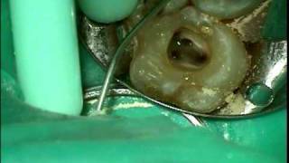 ROOT CANAL! 5 canals!!!  Greatest molar  on youtube! Dr. Jason Deblinger(New York City)