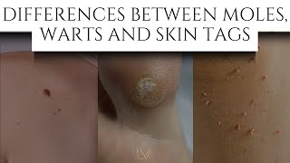 Differences Between Moles, Warts and Skin tags #skincare