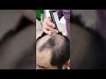 Male Patterned Hair Loss Transformation | Hair System | Bono Hair #shorts