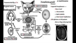 Toxoplasmosis.