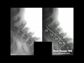 Improvement of cervical anterolisthesis- DMX review with Ross Hauser, MD