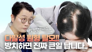 다발성 원형 탈모가 갑자기 생기는 원인!! 당장 치료 받아야 하는 이유!!__[모발이식, 탈모 해결사]