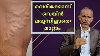 വെരിക്കോസ് വെയ്ൻ മരുന്നില്ലാതെ മാറ്റാം | How to Cure Varicose Veins Naturally | Dr. P A Kareem