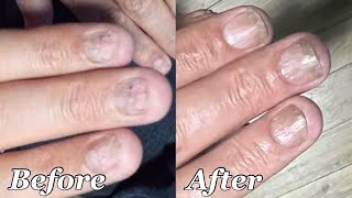 Say Goodbye to Ugly Nails: Effective Fungus Treatment