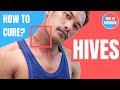 How to treat Hives (Urticaria)? - Doctor Explains