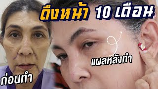 แก้มห้อย หางตาตก คิ้วตก รีวิวหลังดึงหน้า 10 เดือน ไหนรอยเเผล? ธีรพรคลินิก