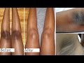 Lighten Dark Elbows, Knees & Underarms Fast!- Kojie Soap Lighten Dark Elbows, Knees & Underarms Fast!- Kojie Soap