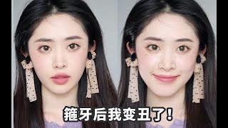 箍牙会变丑？你该知道的整牙后遗症