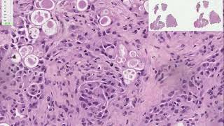 Secretory Meningioma  -  Adventures in Neuropathology