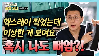 뼈암? 낭종? 당신의 뼈가 걱정된다면 이 영상 확인하세요! - 골통 의사 윤재웅 #36 골육종