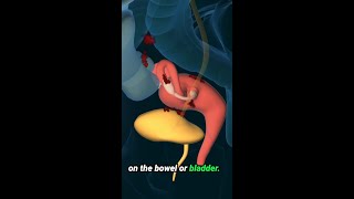 Endometriosis Explained #pain