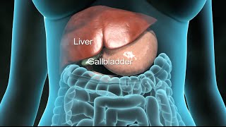 Gallbladder Surgery to Remove Gallstones