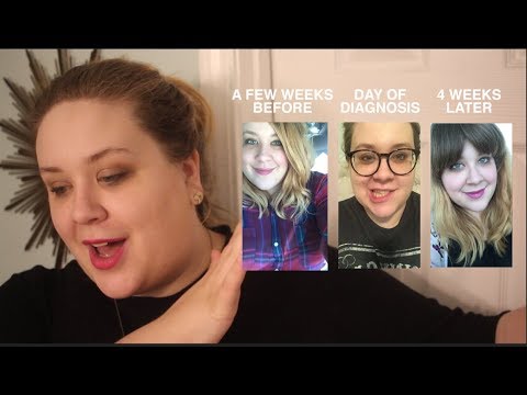Bell's Palsy and Steroid Psychosis and Anxiety Attacks (Oh My)! Bell's Palsy and Steroid Psychosis and Anxiety Attacks (Oh My)!