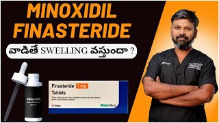 #AskDrJohnWatts | Minoxidil / Finasteride వాడితే swelling వస్తుందా ? | Hair Specialist Explains