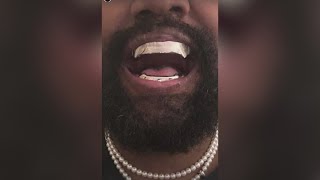 Ye's new grillz sparks rumors of him getting teeth removed