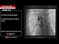 cath case 6 spot the findings cardiology toacs