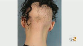 Eczema Treatment Helping Some Alopecia Sufferers Regrpw Hair