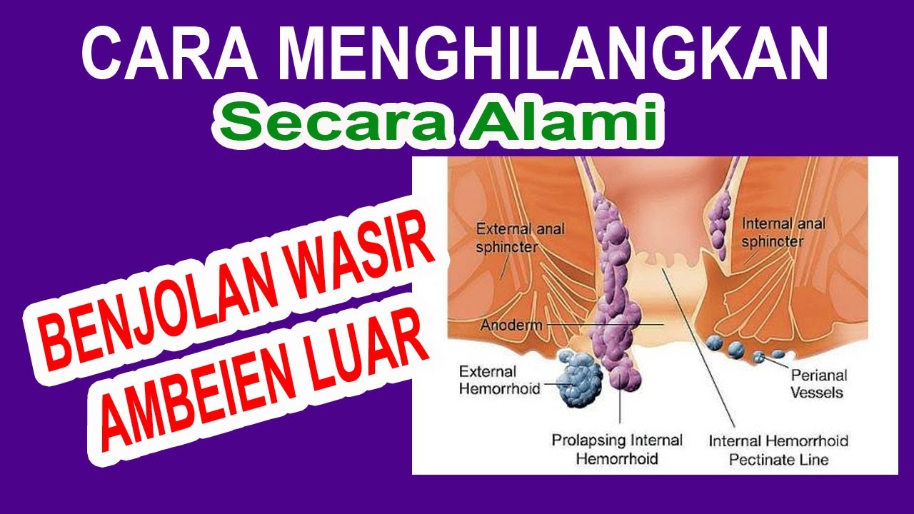 CARA MENGHILANGKAN BENJOLAN WASIR AMBEIEN LUAR SECARA ALAMI | Obat ...