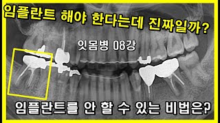 신경치료 문제발생후 빼고 임플란트 꼭 해야하나? 신경치료후 크라운 씌운 29세 환자. 임플란트 하란다고 하지 마세요!