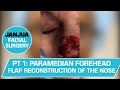 PART 1: PARAMEDIAN FOREHEAD FLAP RECONSTRUCTION OF THE NOSE - DR. TANVEER JANJUA