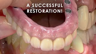 A Successful Restoration with only Posterior Implants