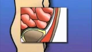 GASTROCIRURGIA - Vídeos - Hérnia Inguinal