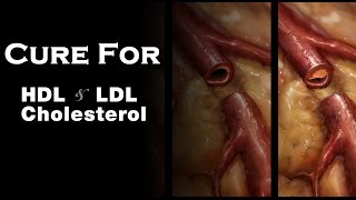 Home Remedies for Reducing High Cholesterol