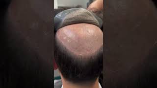 years younger with our natural-looking hair patch service. Say goodbye to hair loss \u0026 bald spots wit