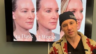 Facelift Recovery 101