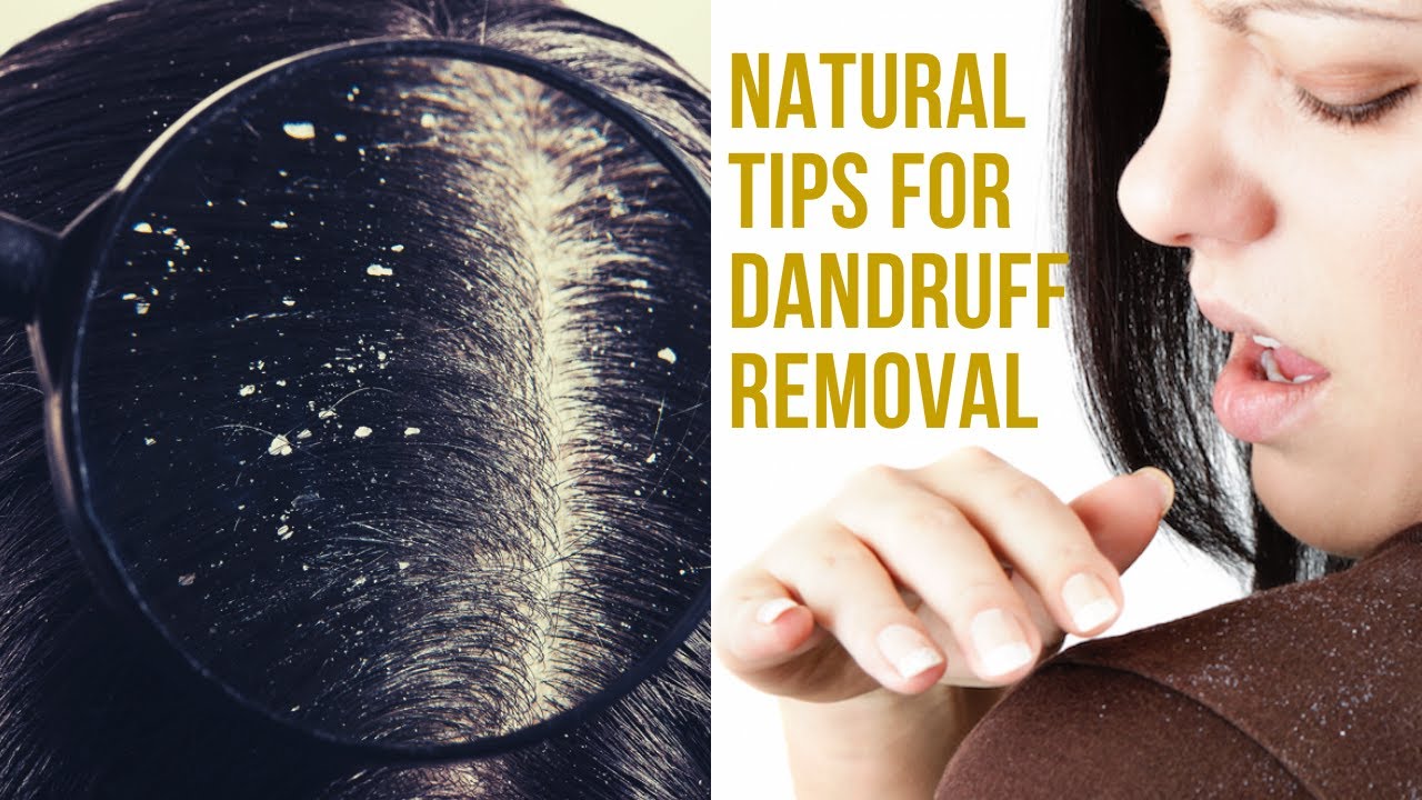 Simple Home Remedies To Get Rid Of Dandruff | Magical Cures For ...