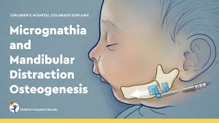 Micrognathia: Treating an Undersized Jaw