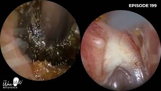 199 - WATCH AN #ENT #SURGEON PERFORM #EARWAXREMOVAL WITH THE WAXSCOPE®️