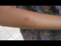 Feline Ringworm Feline Ringworm