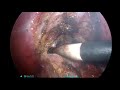 elective laparoscopic cholecystectomy