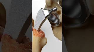 Revision Hip Replacement surgery (3D Animation) #shorts